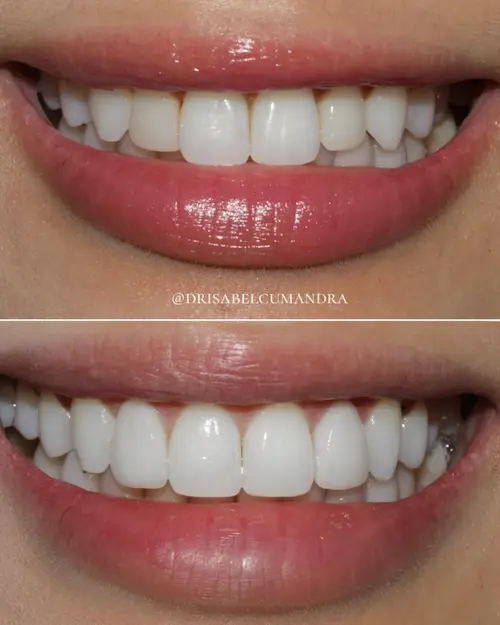 veneers sydney
