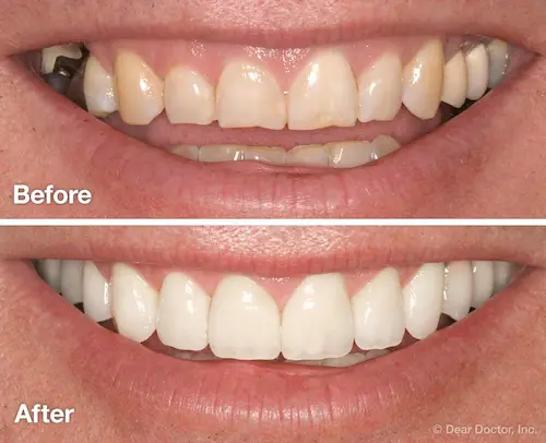 teeth whitening sydney
